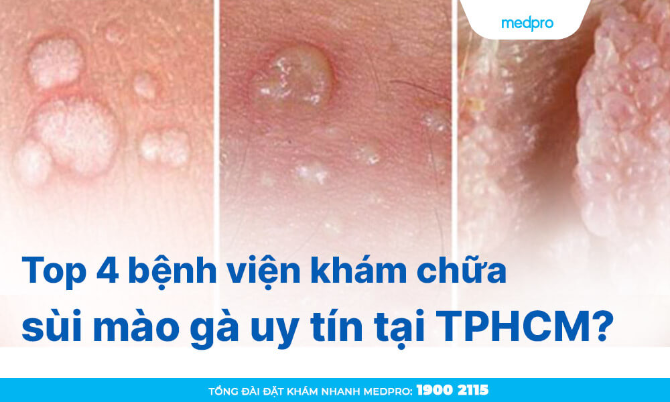 Top 4 bệnh viện khám chữa sùi mào gà uy tín tại TPHCM?
